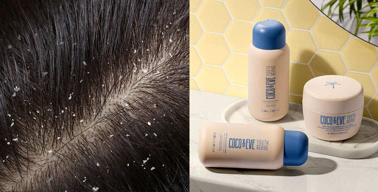 Winter Dandruff: Tips and Natural Remedies for Dandruff